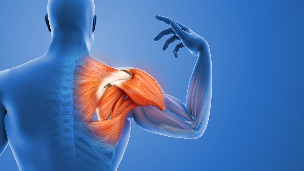 Inflamed shoulder muscle and painful joint highlighting rotator cuff anatomy, muscle strain, and inflammation relevant to rotator cuff tears and surgical decision making