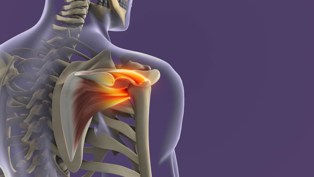 Medical concept of shoulder joint inflammation caused by rotator cuff strain.